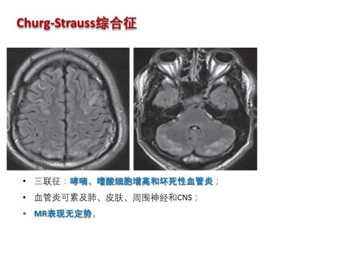 【PPT】中枢神经系统血管炎的临床思考
