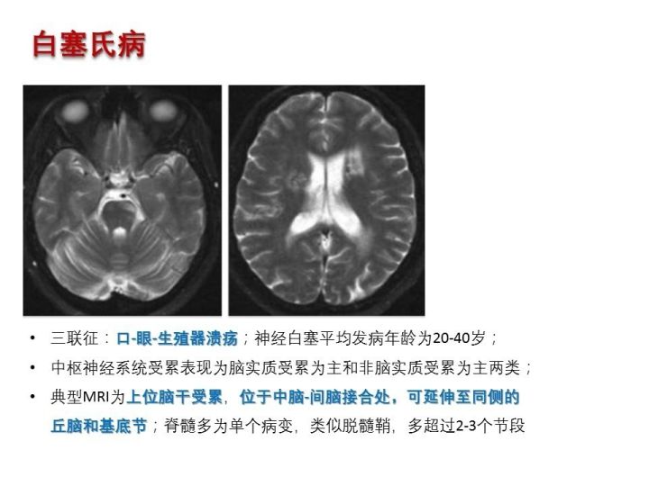 【PPT】中枢神经系统血管炎的临床思考