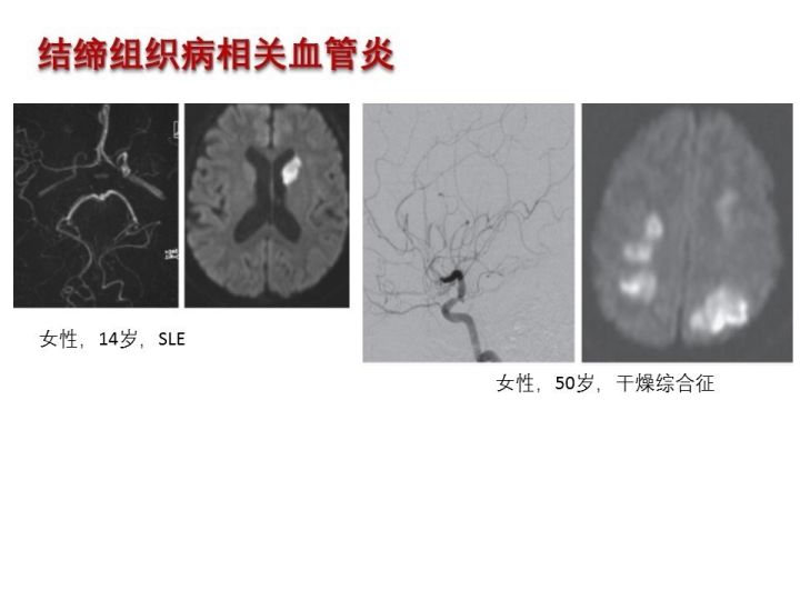 【PPT】中枢神经系统血管炎的临床思考
