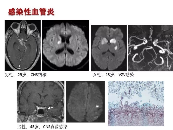 【PPT】中枢神经系统血管炎的临床思考