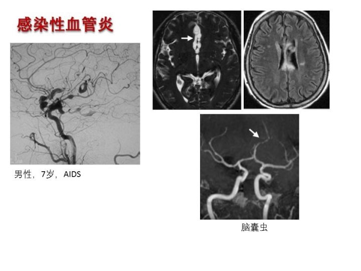 【PPT】中枢神经系统血管炎的临床思考