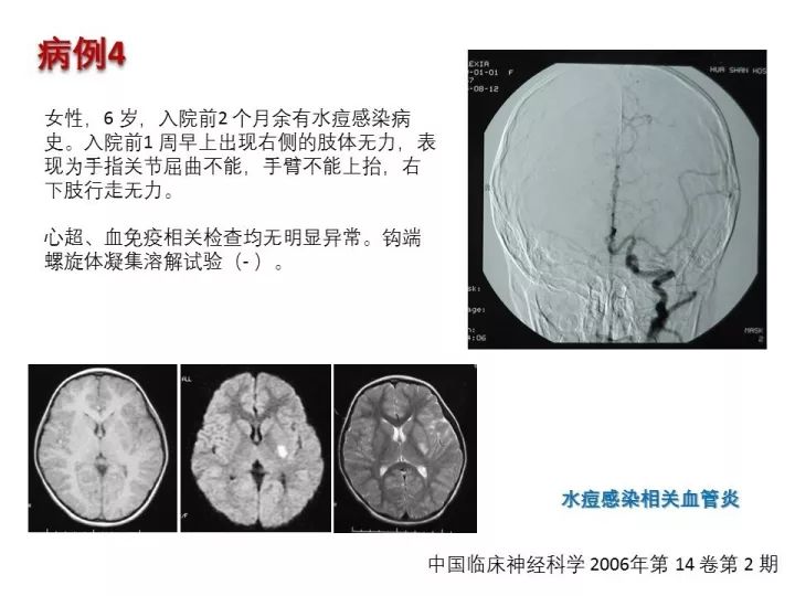 【PPT】中枢神经系统血管炎的临床思考