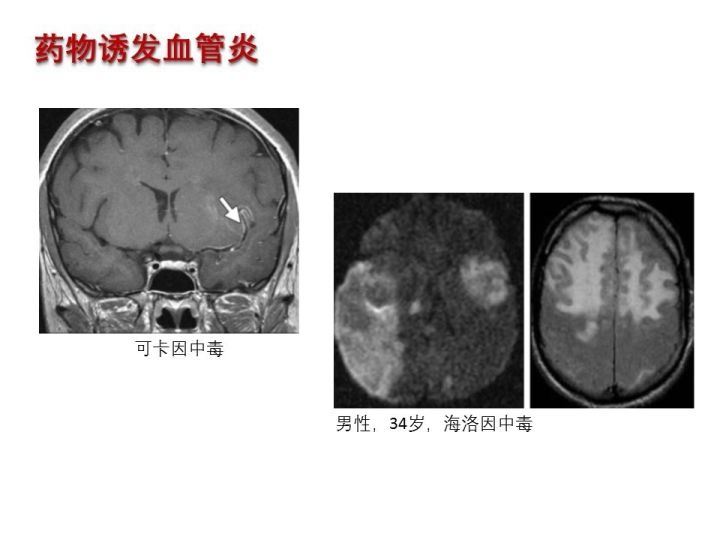 【PPT】中枢神经系统血管炎的临床思考