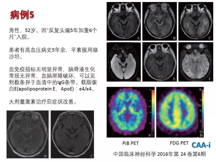 【PPT】中枢神经系统血管炎的临床思考