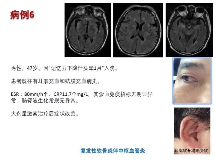 【PPT】中枢神经系统血管炎的临床思考