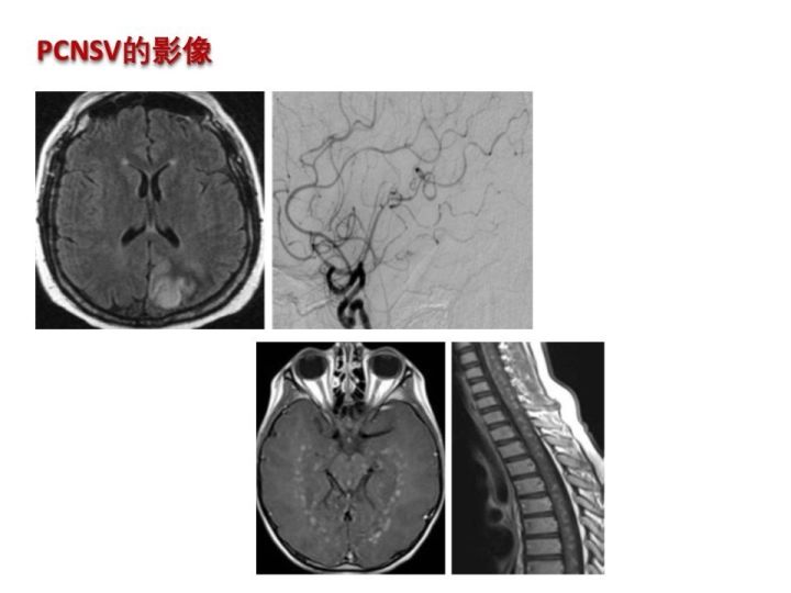 【PPT】中枢神经系统血管炎的临床思考