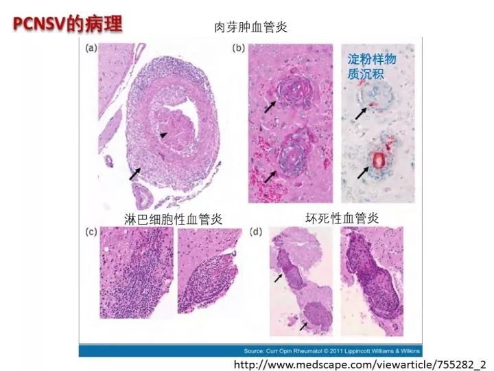 【PPT】中枢神经系统血管炎的临床思考