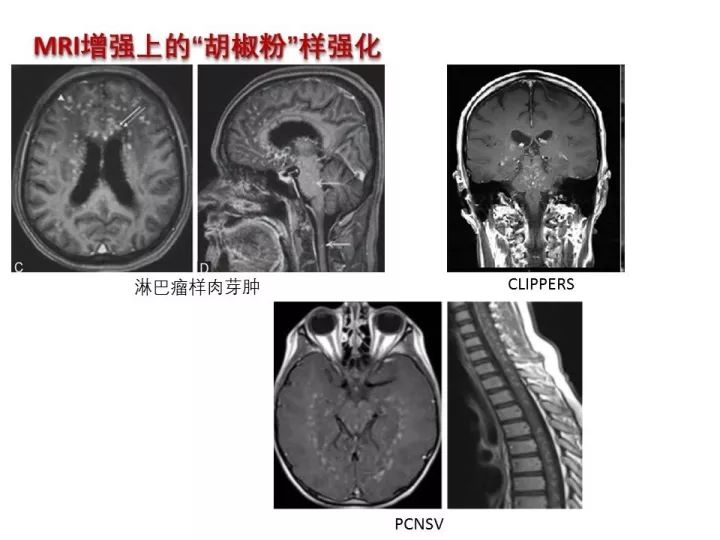 【PPT】中枢神经系统血管炎的临床思考