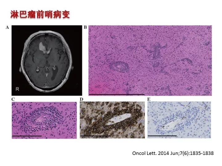 【PPT】中枢神经系统血管炎的临床思考