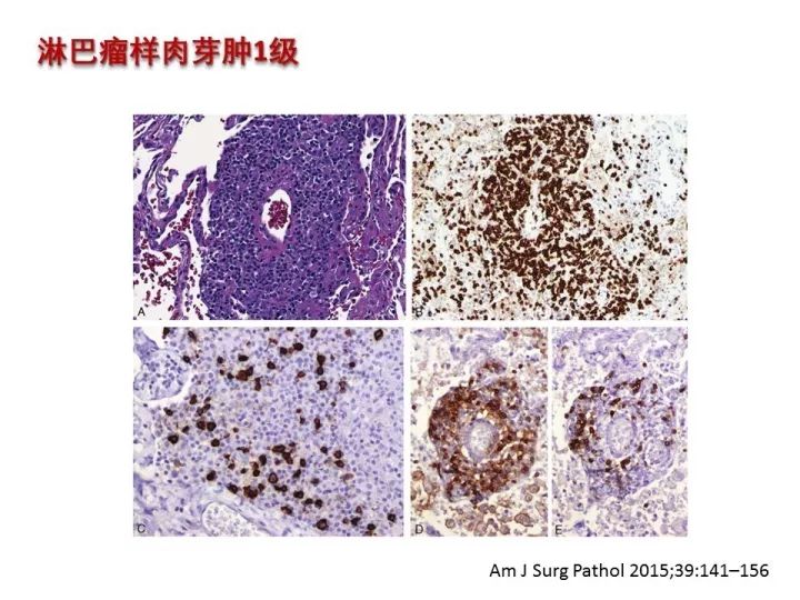 【PPT】中枢神经系统血管炎的临床思考