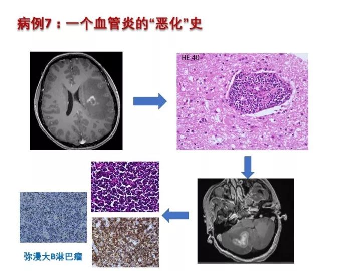 【PPT】中枢神经系统血管炎的临床思考