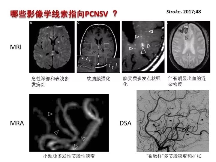 【PPT】中枢神经系统血管炎的临床思考