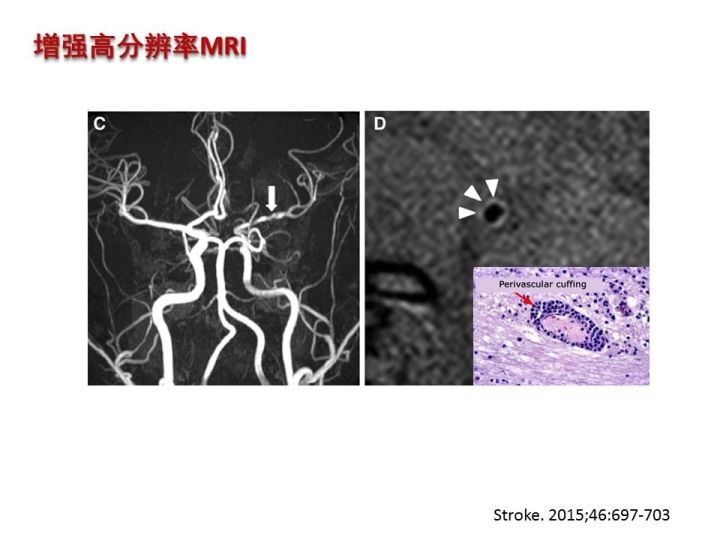 【PPT】中枢神经系统血管炎的临床思考