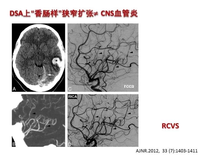 【PPT】中枢神经系统血管炎的临床思考
