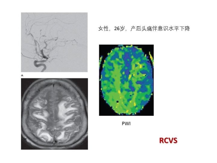 【PPT】中枢神经系统血管炎的临床思考