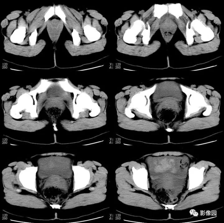 【病例】输卵管妊娠破裂1例CT