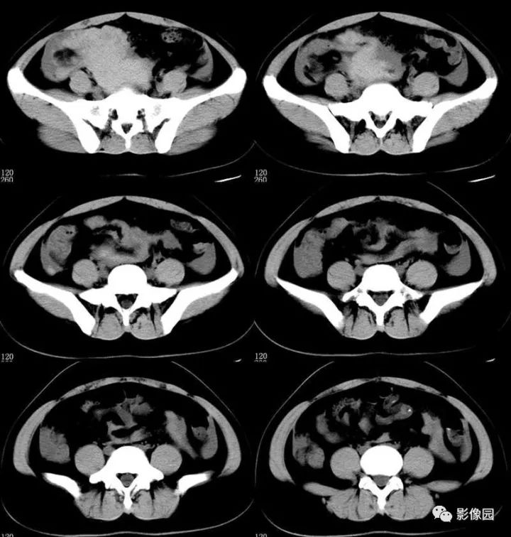 【病例】输卵管妊娠破裂1例CT