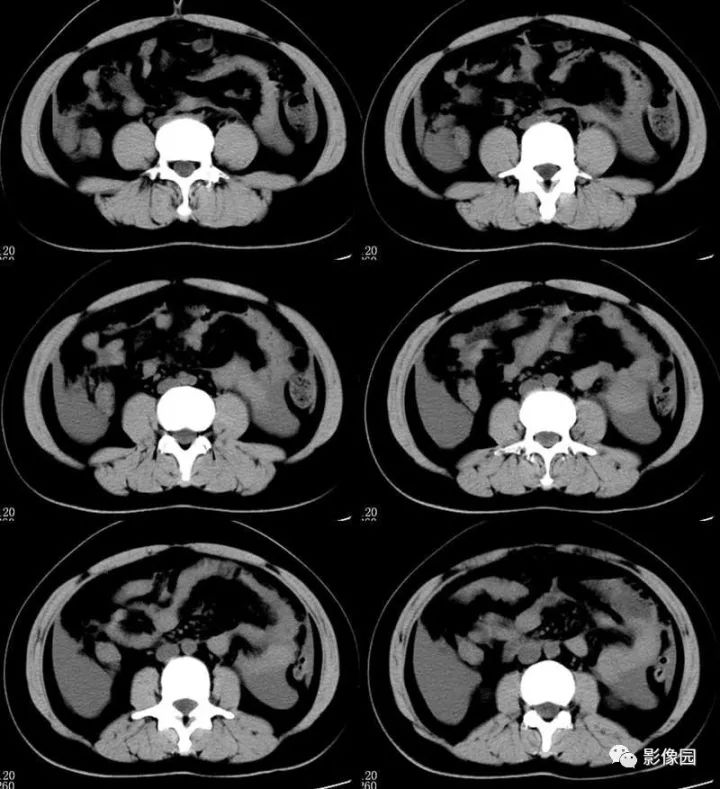 【病例】输卵管妊娠破裂1例CT