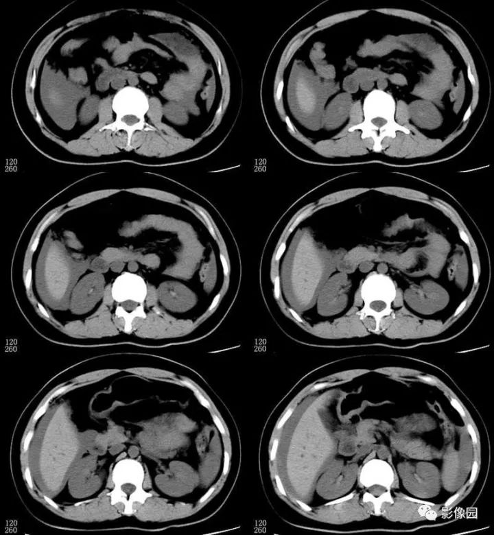 【病例】输卵管妊娠破裂1例CT