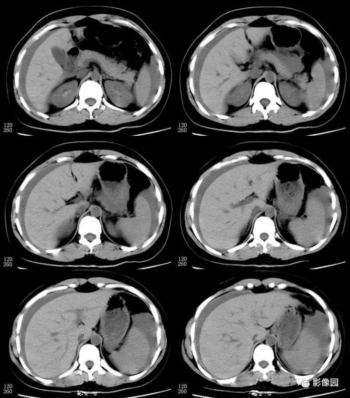 【病例】输卵管妊娠破裂1例CT