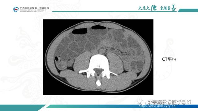 【病例】肠壁异位胰腺1例CT影像表现