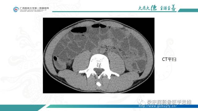 【病例】肠壁异位胰腺1例CT影像表现