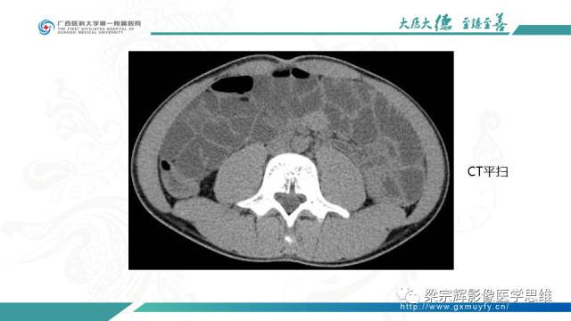 【病例】肠壁异位胰腺1例CT影像表现