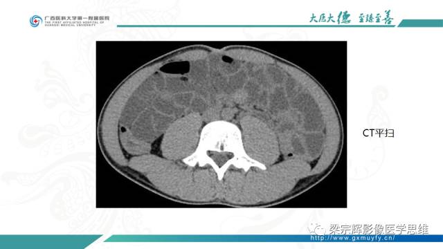 【病例】肠壁异位胰腺1例CT影像表现
