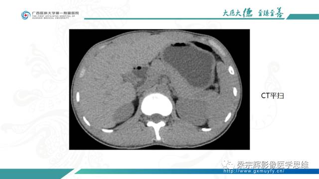 【病例】肠壁异位胰腺1例CT影像表现