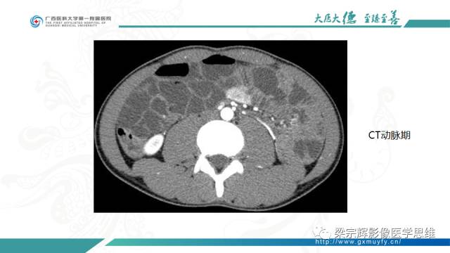 【病例】肠壁异位胰腺1例CT影像表现