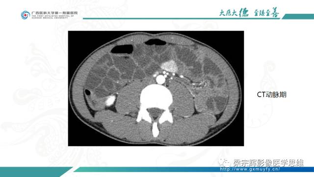 【病例】肠壁异位胰腺1例CT影像表现