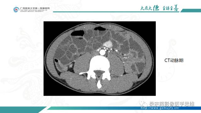 【病例】肠壁异位胰腺1例CT影像表现