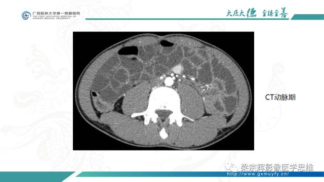 【病例】肠壁异位胰腺1例CT影像表现