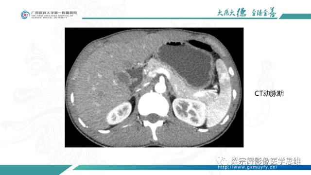【病例】肠壁异位胰腺1例CT影像表现