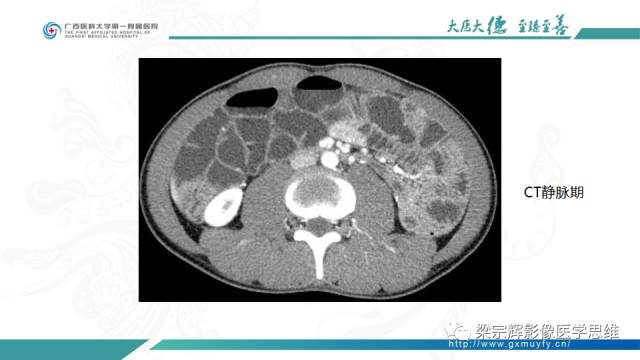 【病例】肠壁异位胰腺1例CT影像表现