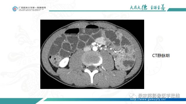 【病例】肠壁异位胰腺1例CT影像表现