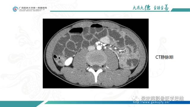 【病例】肠壁异位胰腺1例CT影像表现