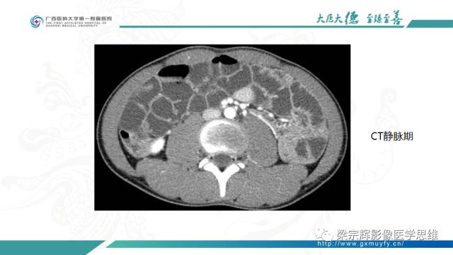 【病例】肠壁异位胰腺1例CT影像表现