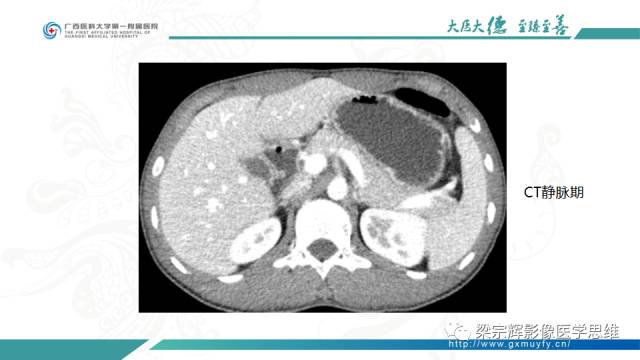 【病例】肠壁异位胰腺1例CT影像表现