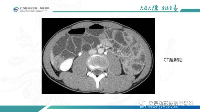 【病例】肠壁异位胰腺1例CT影像表现
