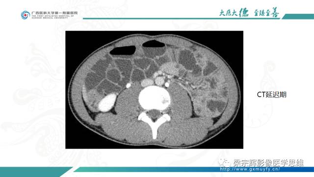 【病例】肠壁异位胰腺1例CT影像表现