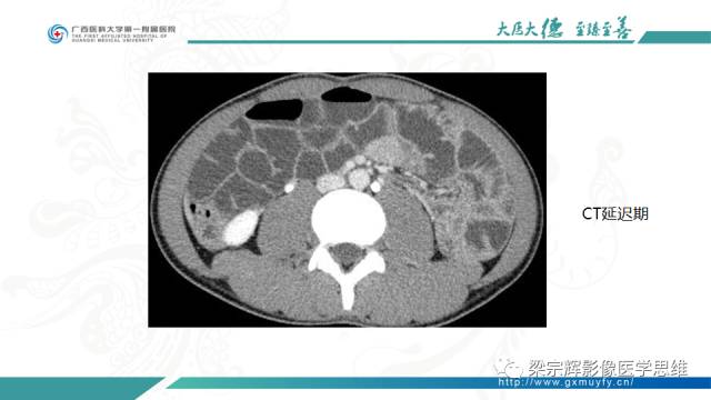 【病例】肠壁异位胰腺1例CT影像表现