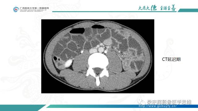 【病例】肠壁异位胰腺1例CT影像表现