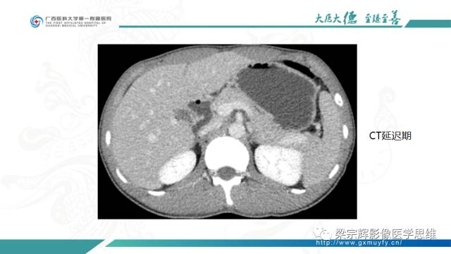【病例】肠壁异位胰腺1例CT影像表现