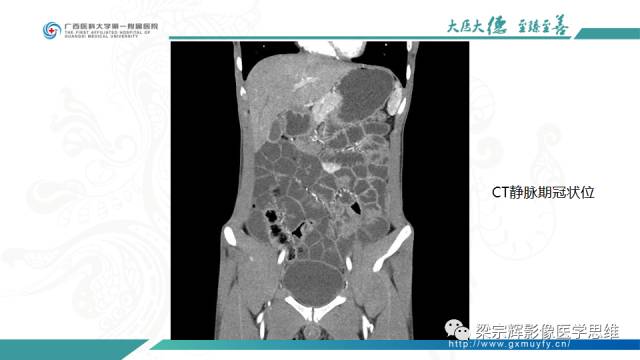 【病例】肠壁异位胰腺1例CT影像表现