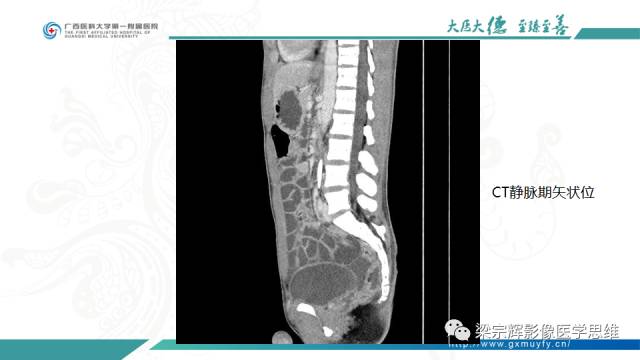 【病例】肠壁异位胰腺1例CT影像表现