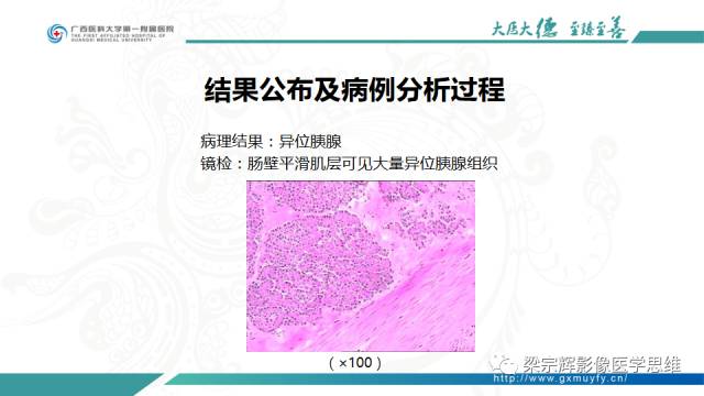 【病例】肠壁异位胰腺1例CT影像表现