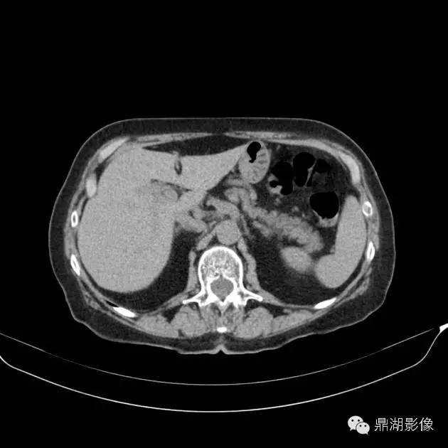 【病例】胰腺异位副脾1例CT 【病例】胰腺异位副脾1例CT