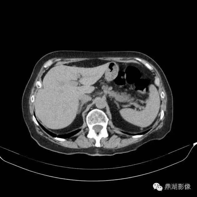 【病例】胰腺异位副脾1例CT 【病例】胰腺异位副脾1例CT