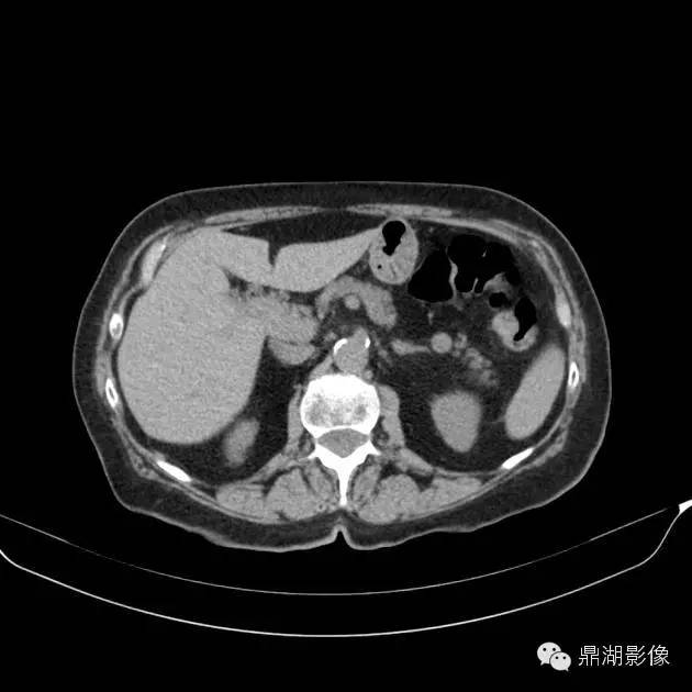 【病例】胰腺异位副脾1例CT 【病例】胰腺异位副脾1例CT